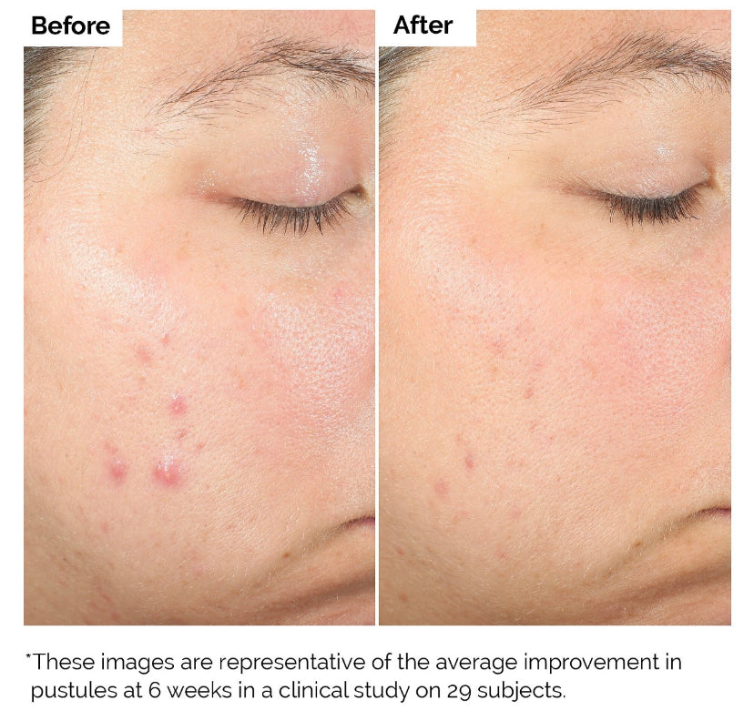 Salicylic Acid 2% Solution - The Ordinary
